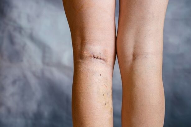suture on the leg after surgery due to varicose veins