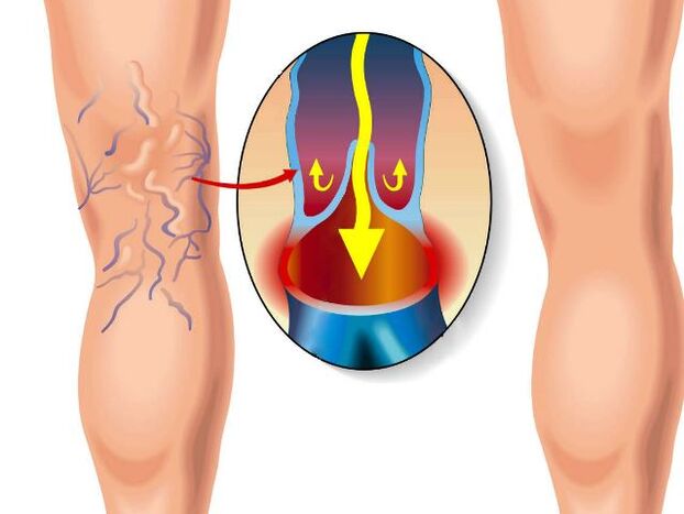 healthy legs and varicose veins in the legs