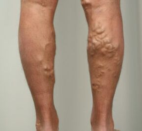 nodules on the legs with varicose veins