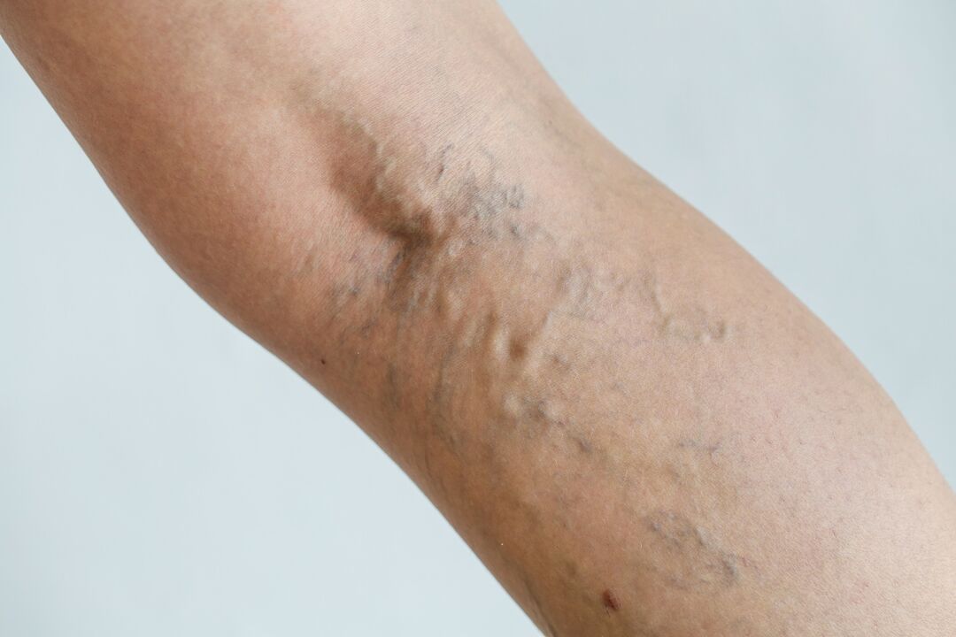 varicose veins on legs photo 1