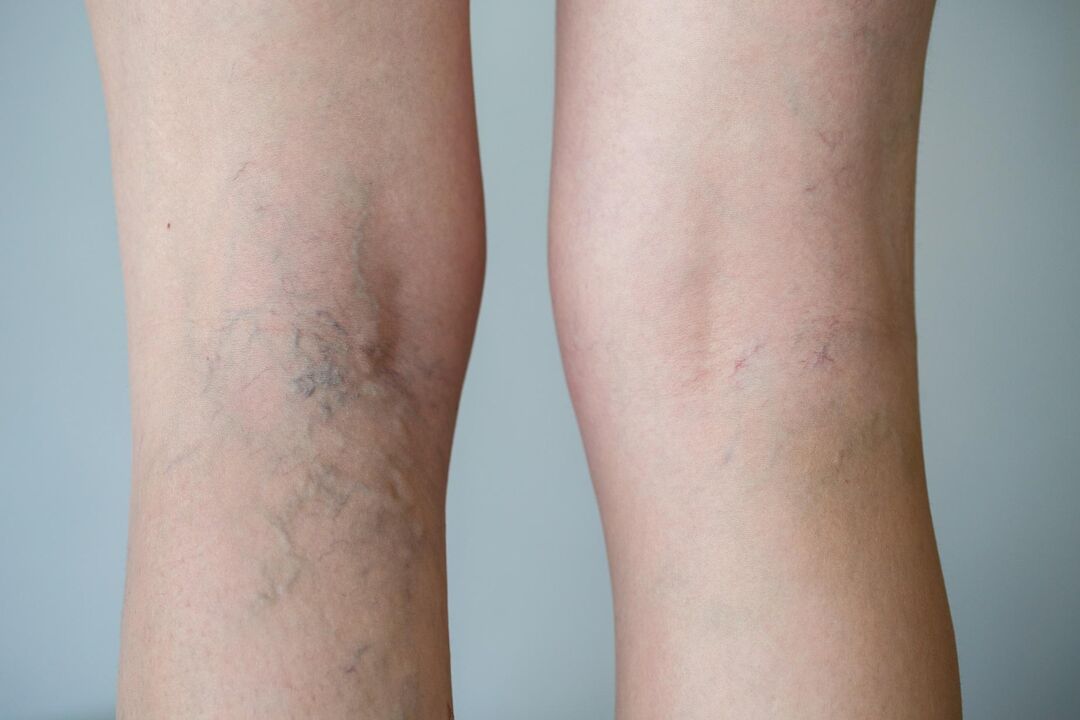 varicose veins on legs photo 2