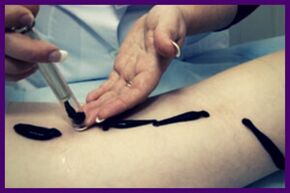 Procedure for the treatment of varicose veins with leeches (chiropractic)