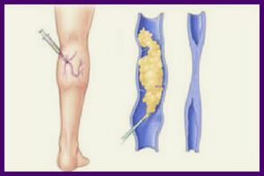 Sclerotherapy is a popular method of resolving varicose veins in the legs