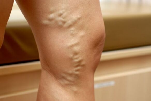 varicose veins on the legs with varicose veins of the pelvis