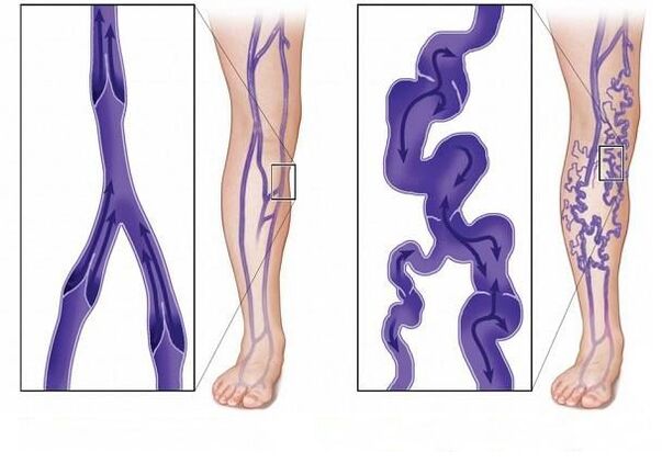 normal venous valves and varicose veins
