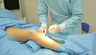 how surgery is performed in varicose veins
