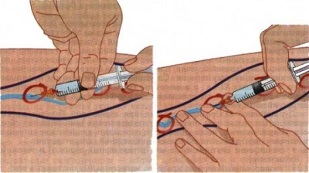 methods of treating varicose veins