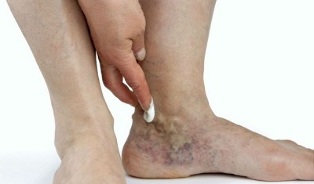 manifestations of varicose veins in the legs