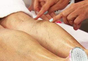 varicose veins of legs in women