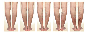 Stages of varicose veins