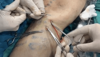 how a phlebotomy is performed to remove varicose veins
